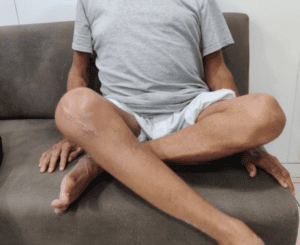 Deformity in knee sitting cross leg post surgery