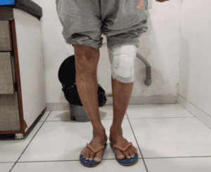 Post knee replacement correction of deformity and perfect alignment