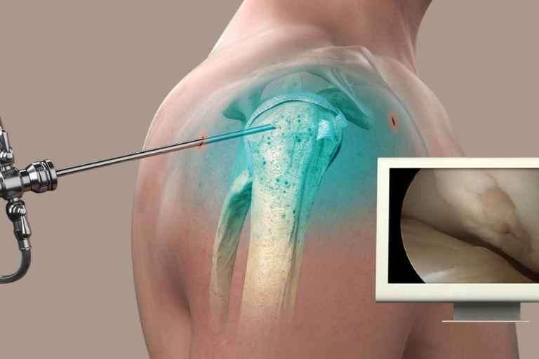 Shoulder arthroscopy