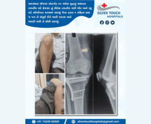 complex fracture and it's outcome