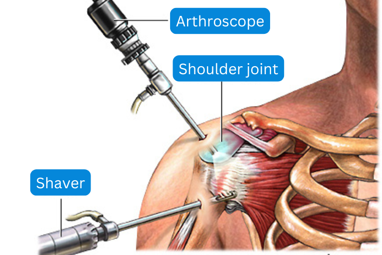 Shoulder arthroscopy