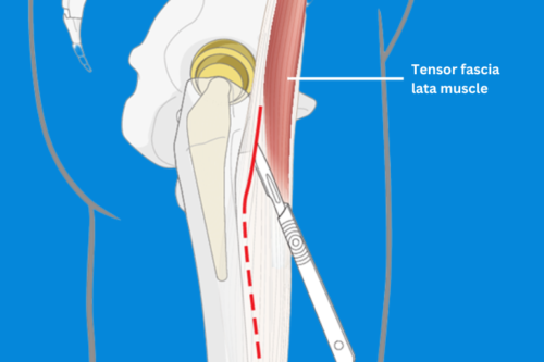 Direct Anterior Approach Hip Replacement