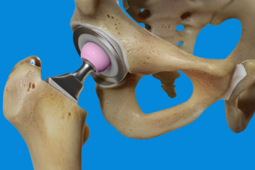 Hip replacement