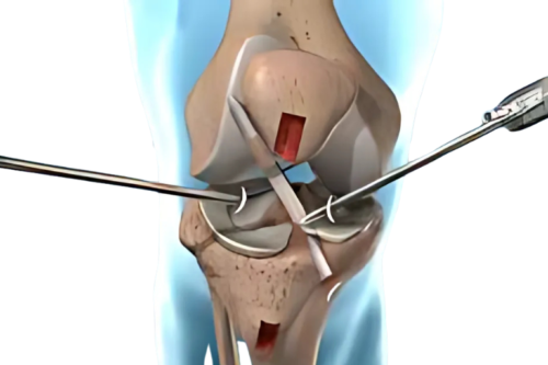 Knee arthroscopy