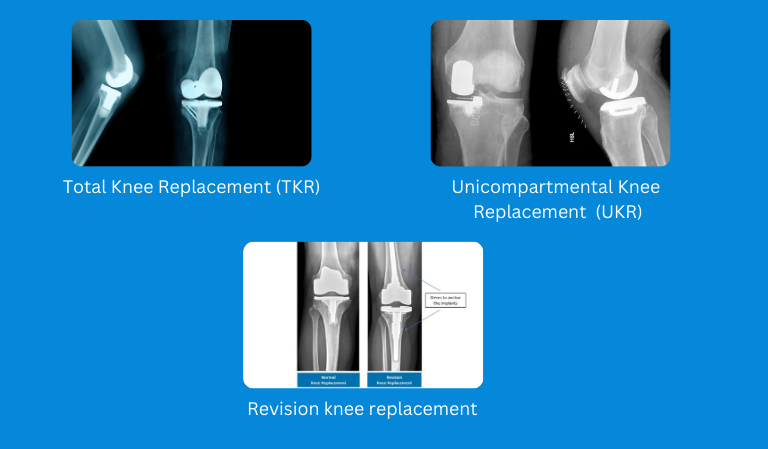 Types of knee replacements