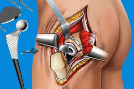 What Is Hip replacement_